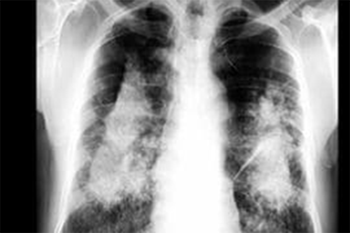 Phim X-quang phổi giúp bác sĩ chẩn đoán bệnh